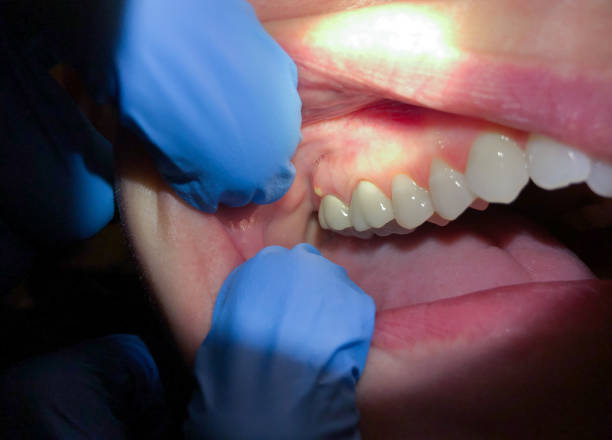 Best Emergency Dental Care for Abscessed Tooth in Freeport, TX